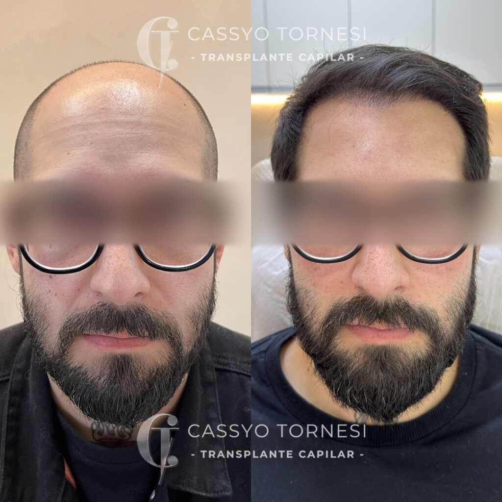 Transplante Capilar FUE Curitiba